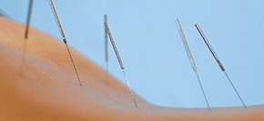 Akupunktur